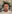 Bulbous nose correction (surgical nasal tip reduction) — Coco Line Clinic