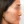 Nose tip filler — before · Erne Clinic