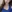 Masseter Botox (jaw slimming / square jaw reduction) — Beauty Line Plastic Surgery Clinic