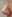 Nasal Tip Plasty with Autologous Cartilage — Uri Plastic Surgery Clinic
