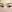 Partial incision double eyelid surgery — Yellow Plastic Surgery Clinic