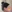 Double chin liposuction (submental liposuction) — Saegim Plastic Surgery Clinic