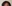 額縮小術（生え際下げ・ヘアライン下降術） — ザフィックス美容外科クリニック