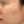 Chemical peel — before (28days) · J.Fill Clinic - Gangnam Branch