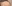 額縮小術（生え際下げ・ヘアライン下降術） — 風が吹く日にも美容外科クリニック