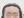 Forehead reduction (hairline lowering surgery) — after (8days) · Goyu Plastic Surgery Clinic