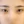 เปิดหางตา — ก่อนทำ (7วัน) · ไฮบอม ศัลยกรรมพลาสติก