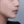 Surfect Lifting (4MHz monopolar RF lifting) — after (7days) · Only Lift Clinic