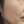 Potenza 黄金微针（黄金射频微针） — 术前 · 一零三医美诊所
