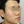 Vビームパーフェクタ（VビームⅡ／色素レーザー） — 術後 (116日) · グデゴウン皮膚科クリニック