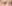 下眼瞼下制術（グラマラスライン形成・たれ目形成） — プロミス美容外科クリニック