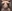 abdominal liposuction — Le Rose Clinic