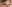 裏ハムラ法（経結膜的眼窩脂肪移動術） — アイニーク美容外科クリニック