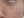 皮下分离术（Subcision，痘坑松解） — 术前 (21天) · The Ollim医美诊所