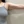 Brachioplasty (arm lift) — before (30days) · Cheongdam OK Plastic Surgery Clinic
