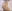 Liposuction revision (corrective liposuction) — Line & View Clinic