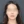 two-jaw surgery (bimaxillary orthognathic surgery) — after (90days) · ReFace Dental Hospital