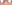 裏ハムラ法（経結膜的眼窩脂肪移動術） — A-Top美容外科クリニック