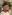 Bulbous nose correction (surgical nasal tip reduction) — Coco Line Clinic