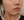 PRP skin rejuvenation (platelet-rich plasma therapy) — before (7days) · U&Me Clinic - Hongdae Branch