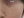 皮下分离术（Subcision，痘坑松解） — 术后 (21天) · The Ollim医美诊所