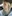 Facial fat grafting (autologous fat transfer to the face) — Pleasure Plastic Surgery Clinic