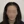 Scalp hair transplant — after (10days) · Okgeon Hairline Clinic