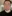 Double chin liposuction (submental liposuction) — Shinsang Plastic Surgery Clinic