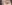buried suture (non-incisional) double eyelid surgery — Seoul Eye Plastic Surgery Clinic