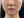 童颜针（舒颜萃/Sculptra）法令纹 — 术前 (30天) · Monster诊所