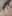 Lower Eyelid Fat Repositioning (transconjunctival) — Uri Plastic Surgery Clinic